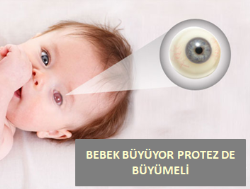 Bebekte Hareketli Göz Protezi Uygulaması