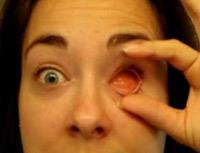 Göz Protezi : Enükleasyon Nedir?